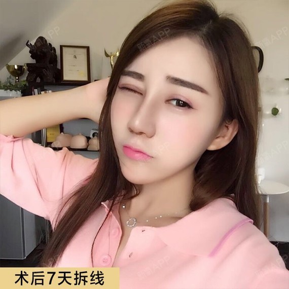 离小仙女只差一个鼻子名字:小念术前特征:鼻根