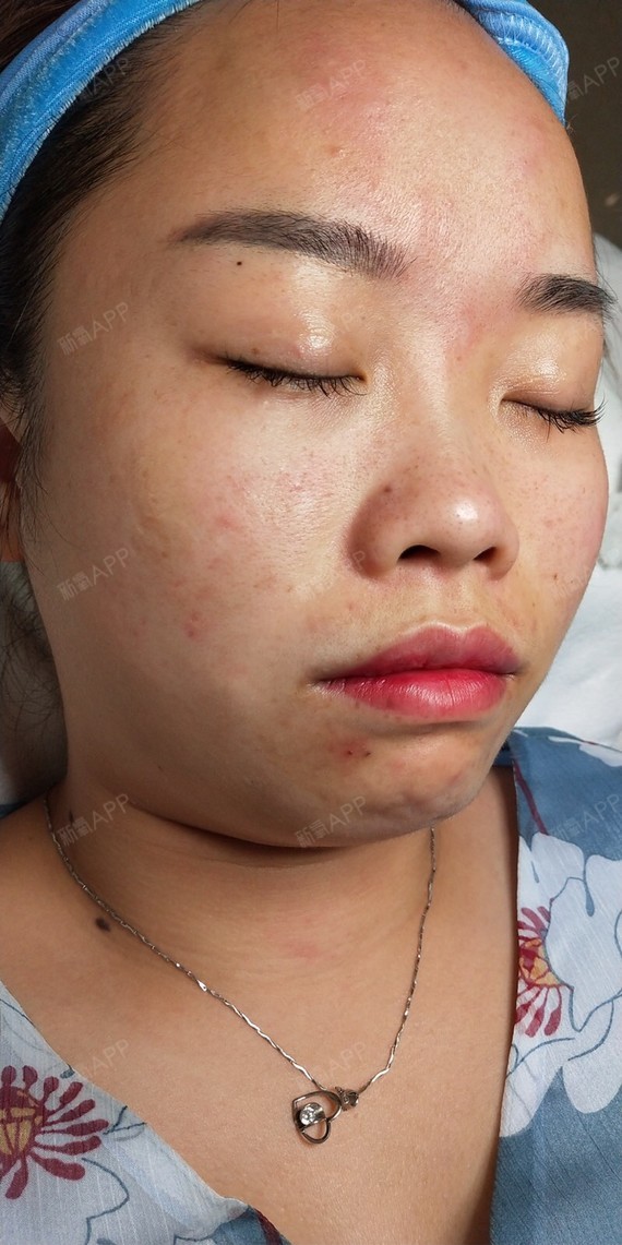 十天不到,我的痘痘大部分结痂,大脓包和结节还在清理_圈子-新氧美容