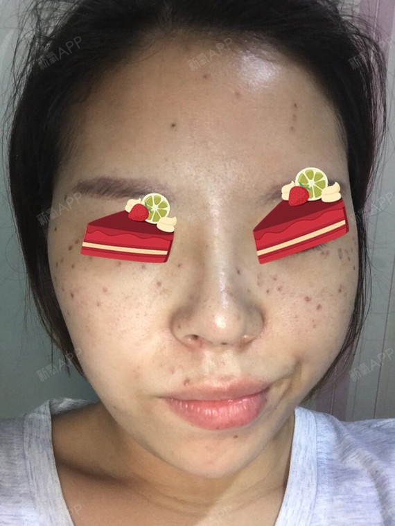 给我做皮秒激光手术的医生是罗俊院长 他说我脸上的痣用这个超皮秒仪