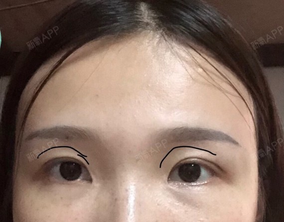 凹陷能用脂肪填充嘛会不会出现硬填条广州或者深圳中山有会填眼窝的