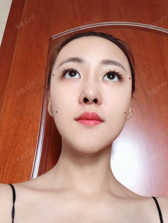 新氧- 我不敢喝雪碧我怕透心凉1 | 面部轮廓 | 额头 | 太阳穴 | 自体