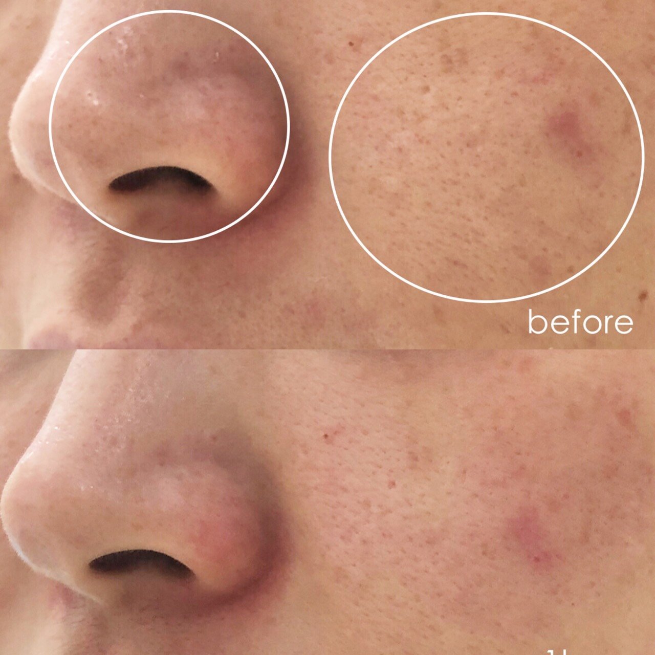 混合干敏肌的逆袭经历 — 风靡ins的国际化皮肤护理mesotix【美提塑】