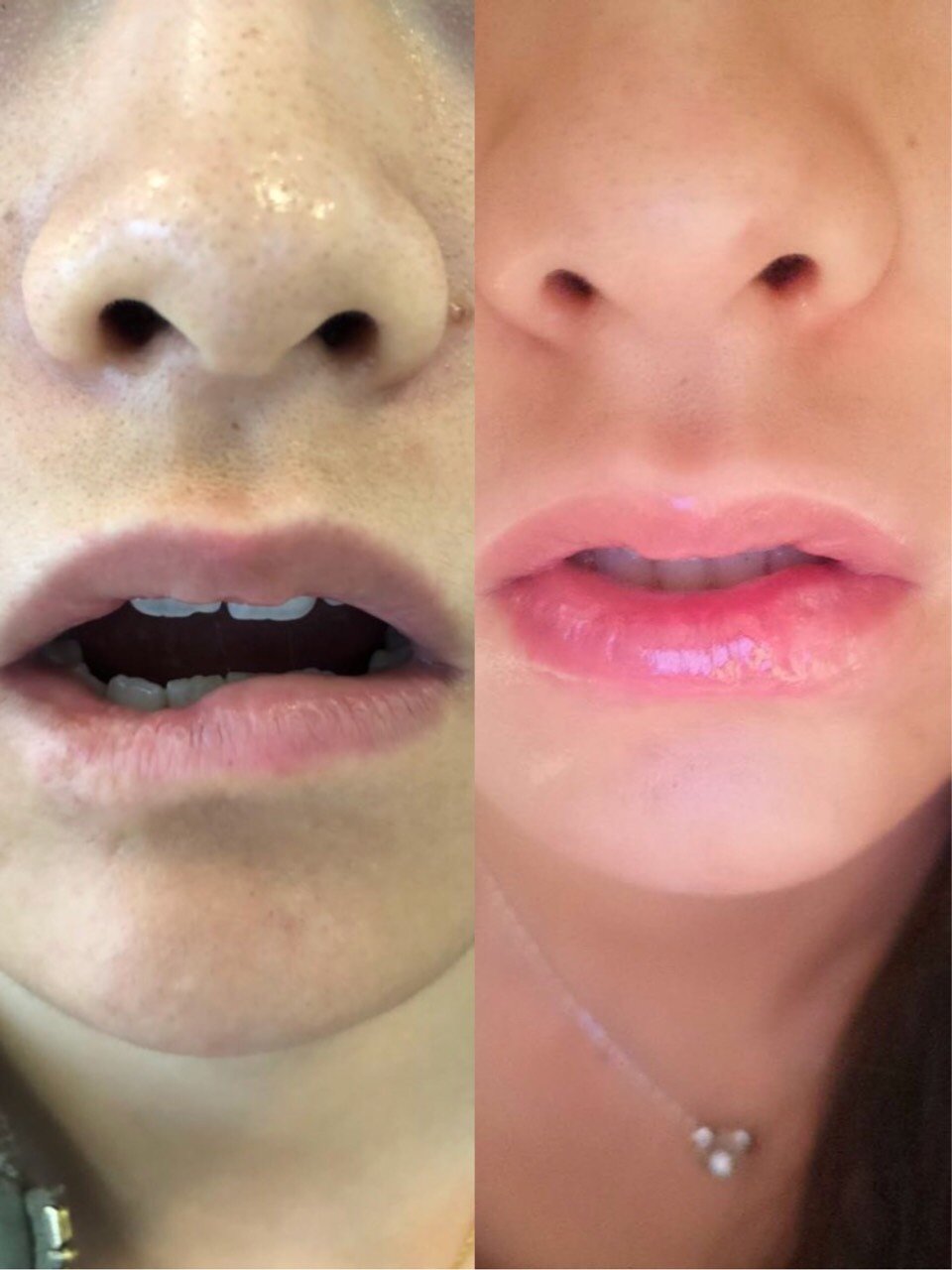 说一说唇部缺陷唇部修复手术