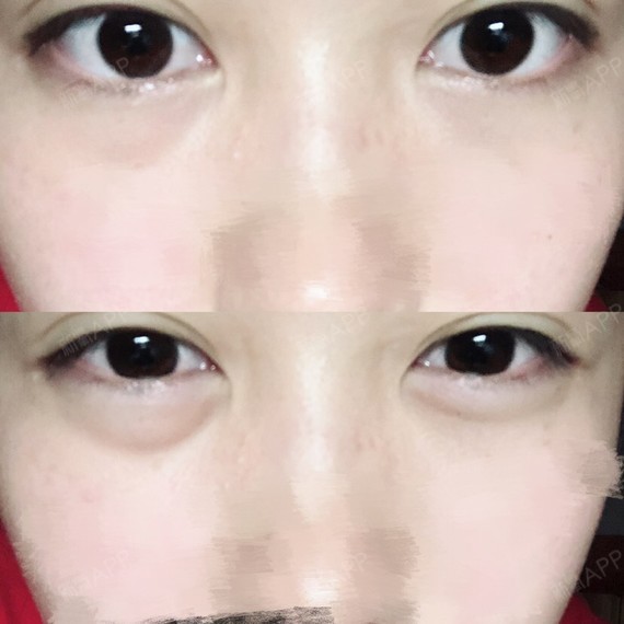 这个……一大一小的眼袋 要怎么解决