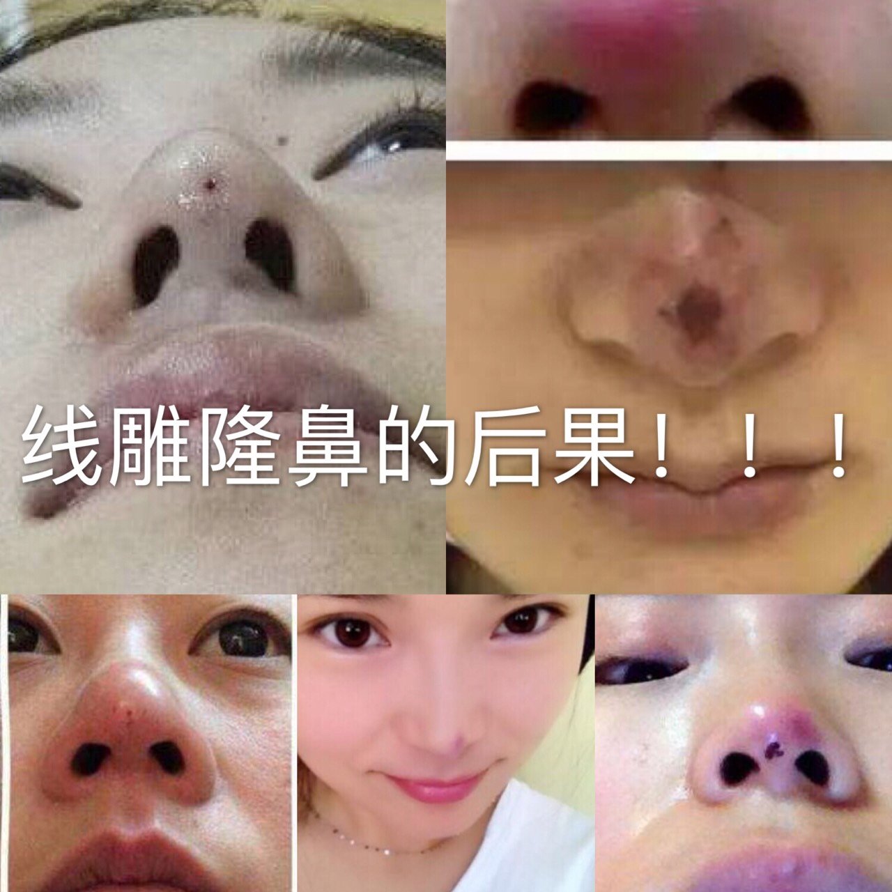 线雕隆鼻在国外是被禁止的07超详细线雕隆_圈子-新氧美容整形