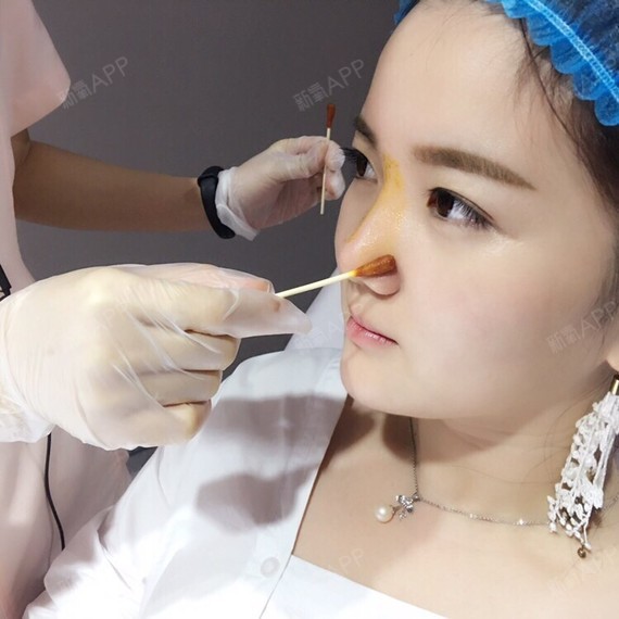 小清新哈哈玻尿酸隆鼻第4天美丽日记