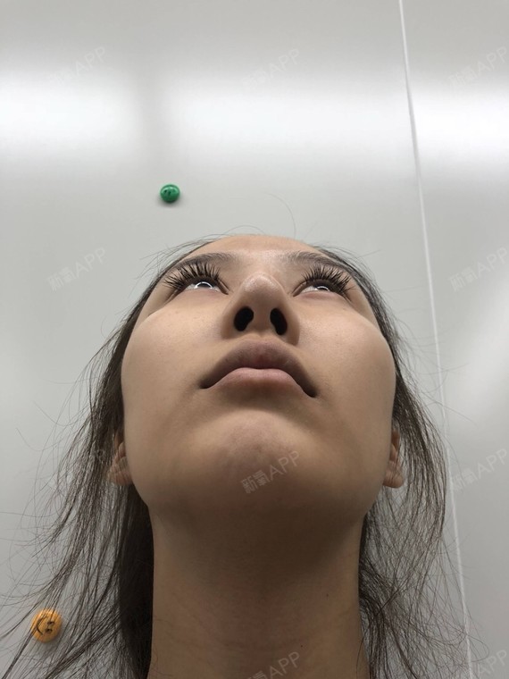 成都肋软骨隆鼻好不好_效果图_丽莎夫人肋软骨隆鼻术后第0天_新氧美容