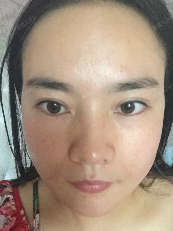 4:20分做了以色列飞顿360祛斑,无痛.