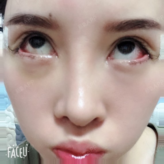 开外眼角