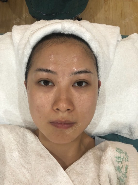 重庆光子嫩肤好不好_效果图_氧气x89gu光子嫩肤术后第4天_新氧美容