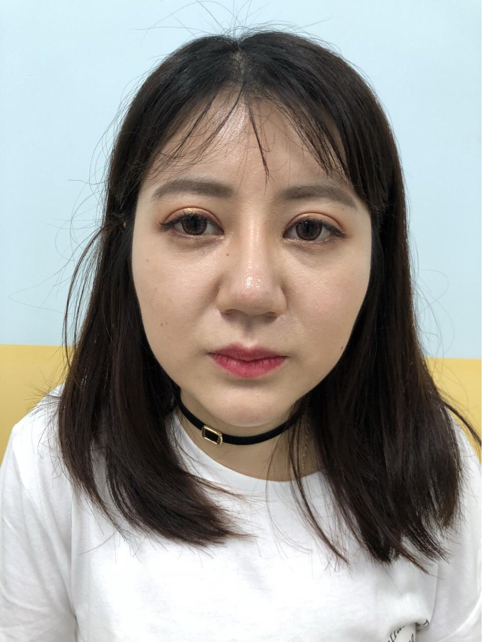 多眼皮变双眼皮"电倒"俄罗斯大汉见过多层_圈子-新氧美容整形