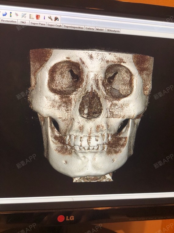 轮廓针打完会很松吧,下垂怎么办,尽量推到8到10,_圈子-新氧美容整形