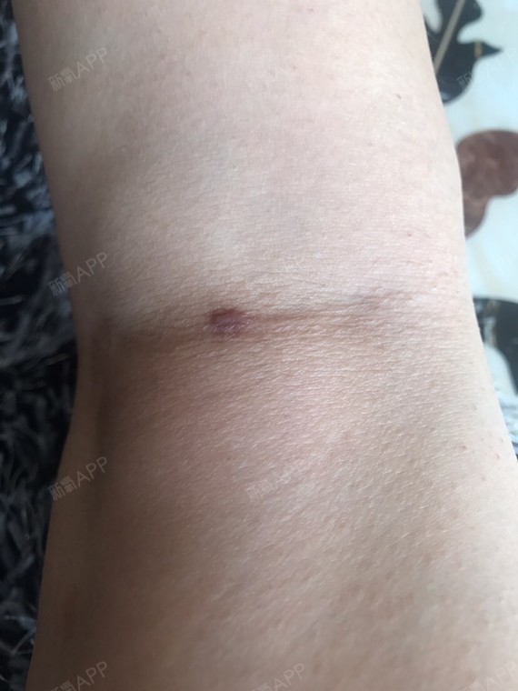 术后30天更新啦