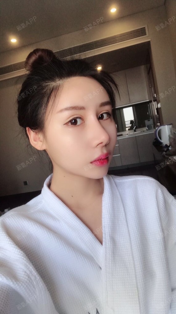 自体脂肪全脸填充好不好_效果图_思琪琪自体脂肪全脸填充术后第202天
