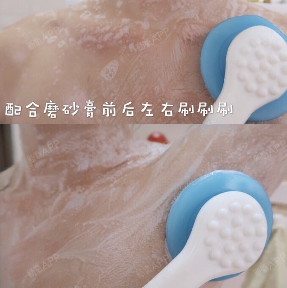 背部长痘主要一个原因是油性皮和角质层厚,很