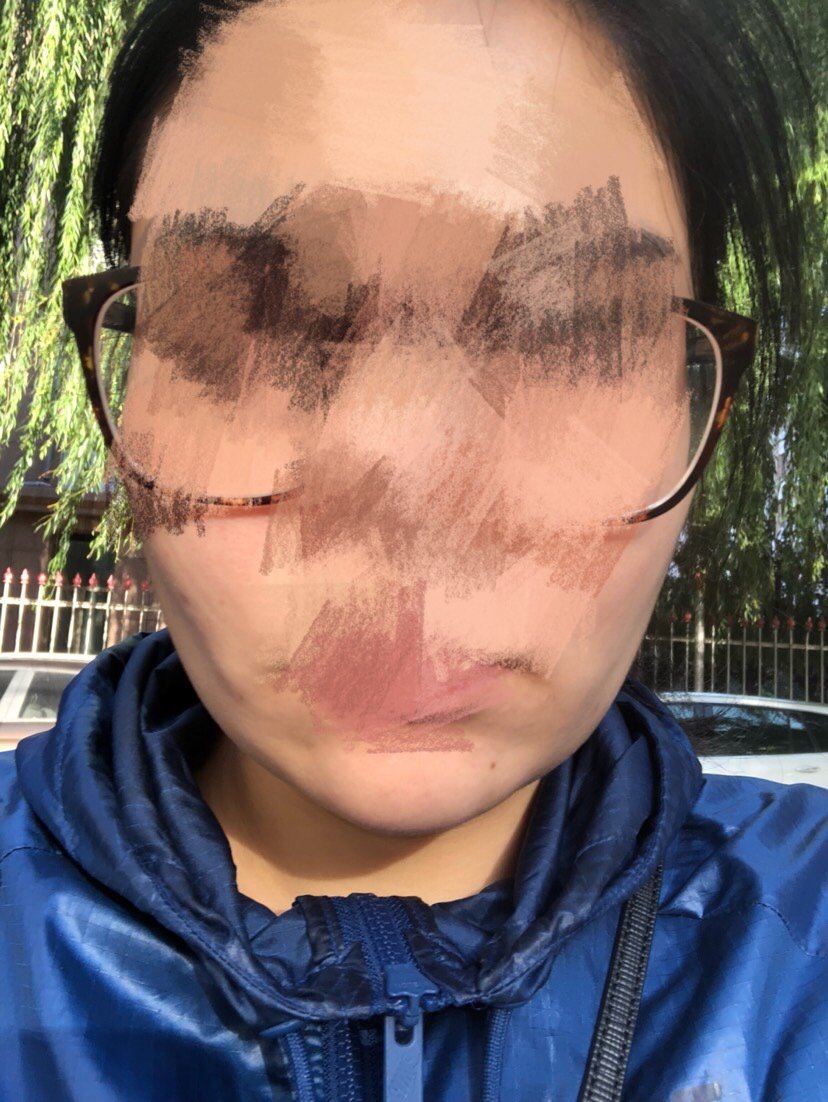 面部吸脂后出现非常严重的凹陷,两边脸明显不对称,真_圈子-新氧美容