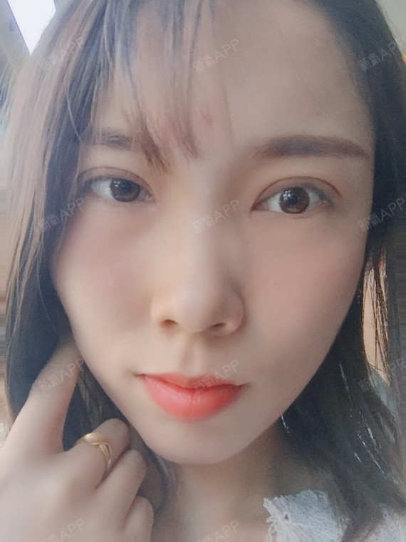 全切双眼皮做完18天了,感觉还是肿啊,应该就是大家说的肉条!