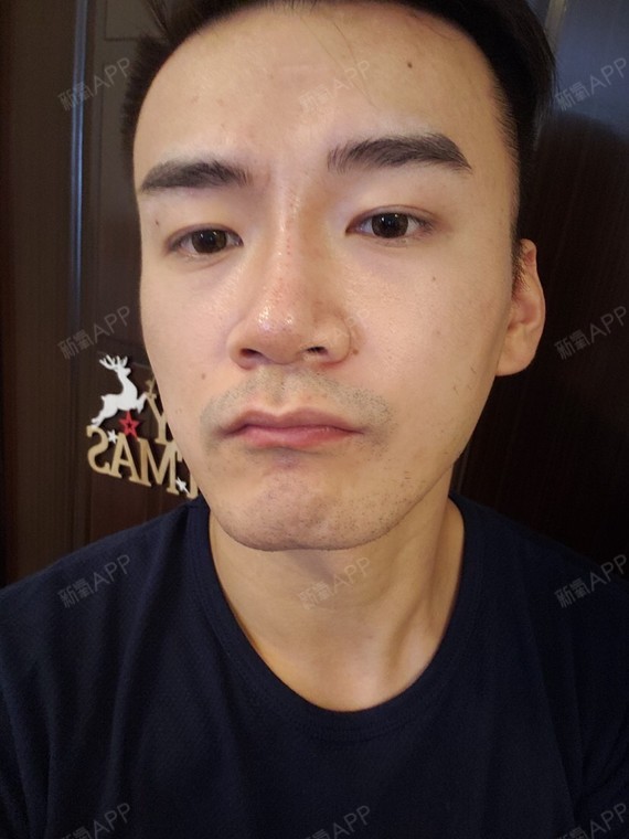 希望看到变高后的山根是不是真的会有比较大的改善.
