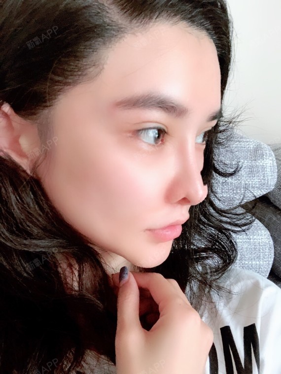 耳软骨复合隆鼻好不好_效果图_小美妞kk耳软骨复合隆鼻术后第361天