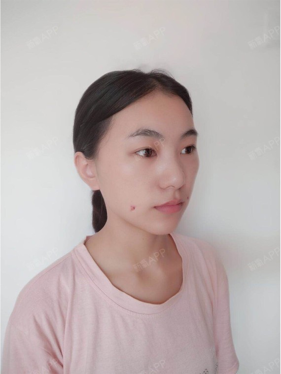 酒窝成形术