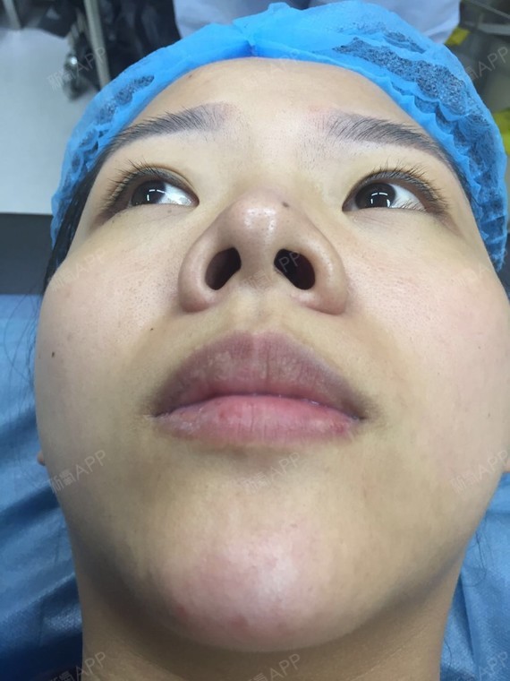 长沙肋软骨隆鼻好不好_效果图_xy婷婷肋软骨隆鼻术后第2天_新氧美容
