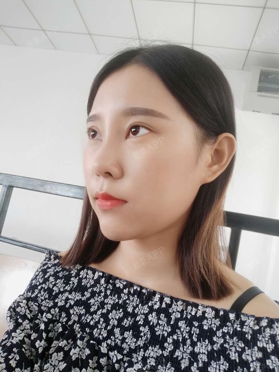 氧气xvpz1埋线隆鼻术后第7天美丽日记_新氧整形