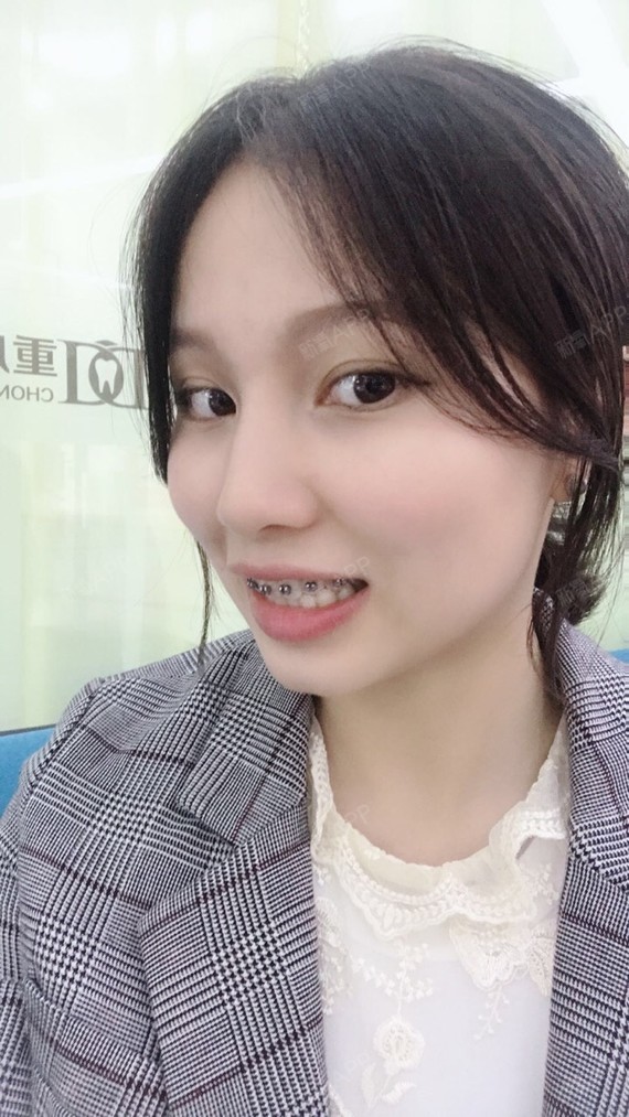 很多人都说我的牙齿很整齐,都说不用矫正,事实也是非_圈子-新氧美容