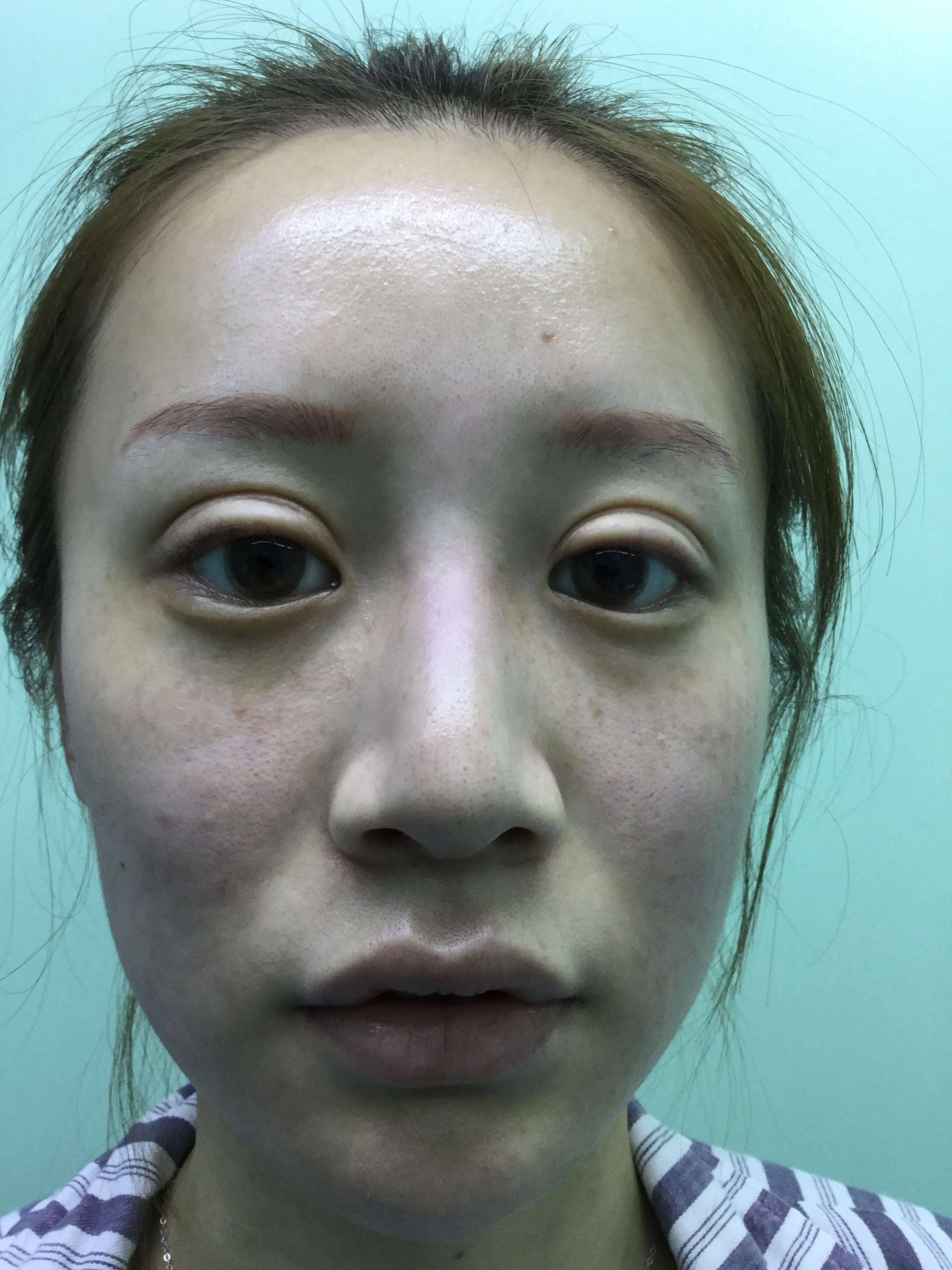 鼻整形手术效果真实记录：5个月，看看淡颜女生是如何变美的？-京东健康
