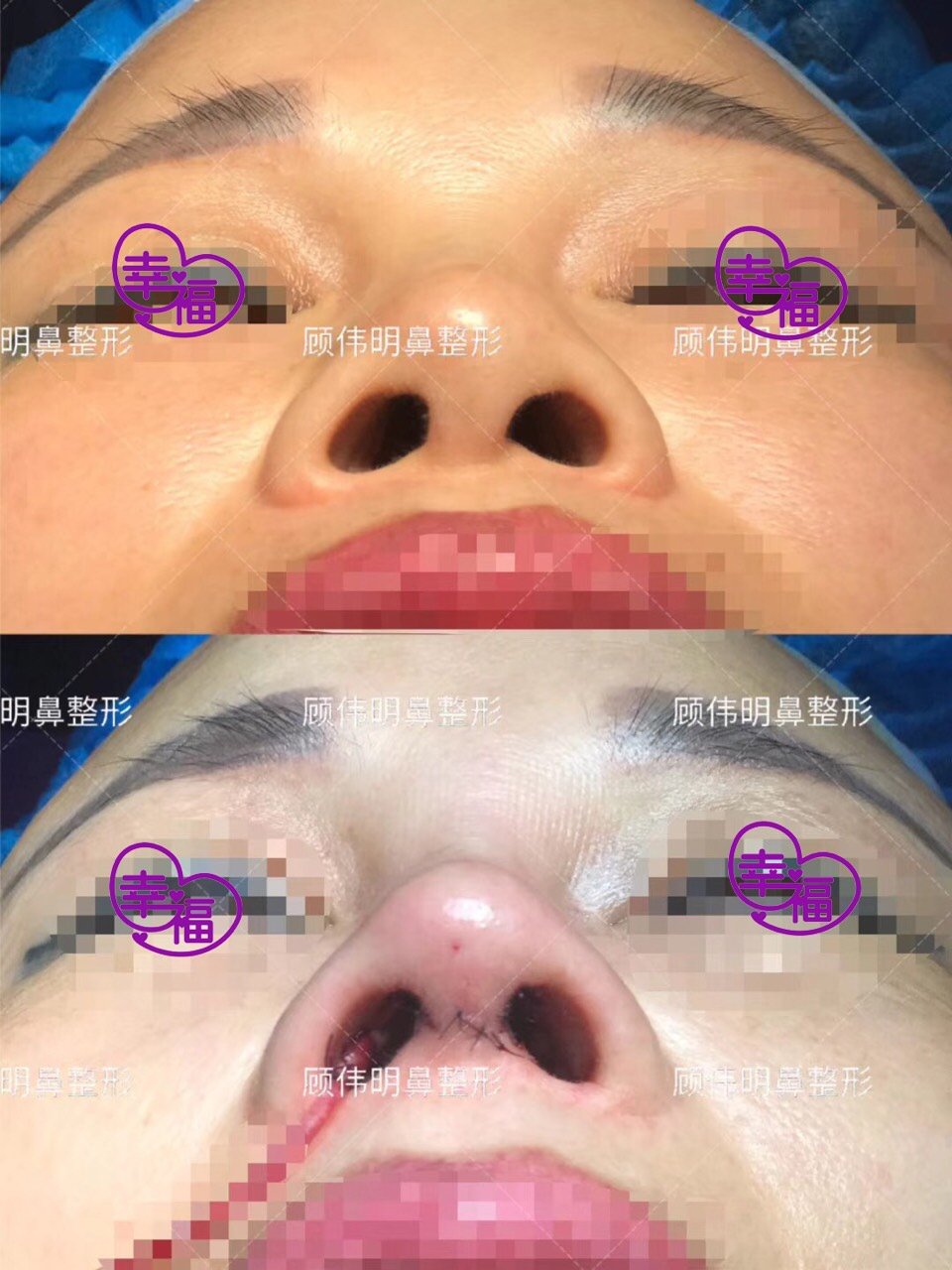 每天一台肋骨鼻##肋骨鼻术后即刻#单纯隆鼻术后两_圈子-新氧美容整形