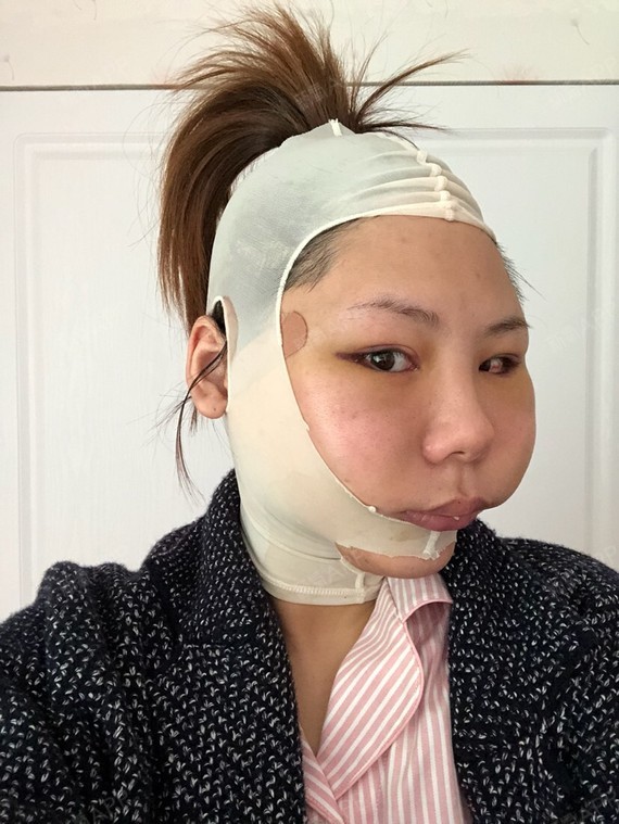 aliasc颧骨颧弓整形术第5天美丽日记