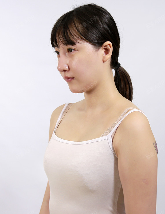 广州自体脂肪隆胸好不好_效果图_wind文自体脂肪隆胸术后第44天_新氧