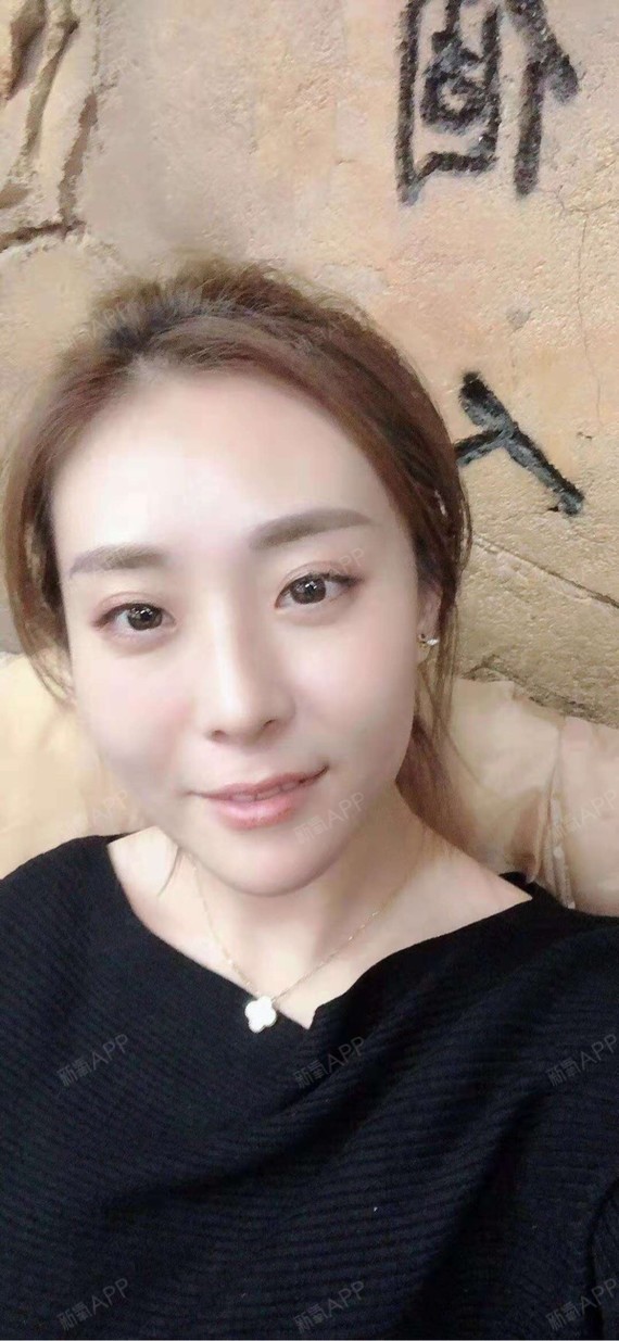 现在的下巴轮廓很自然了,不知道是我体质好的原因还是_圈子-新氧美容