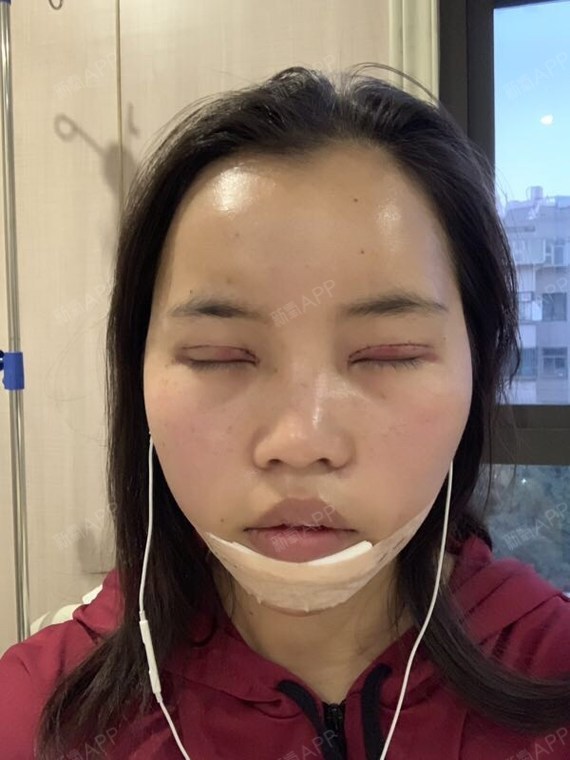 夏娃娃008上颚前突/天包地术后第2天美丽日记_新氧整形