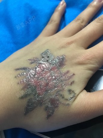 激光纹身一个星期后明显比第一次淡了很多