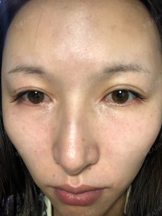 今天去了天使名源做了内吸去眼袋的第一天先给大家一个小小的分享心得