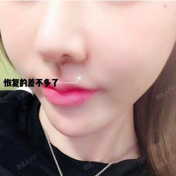 变美模范生||【人中缩短】术后恢复分享,答疑人