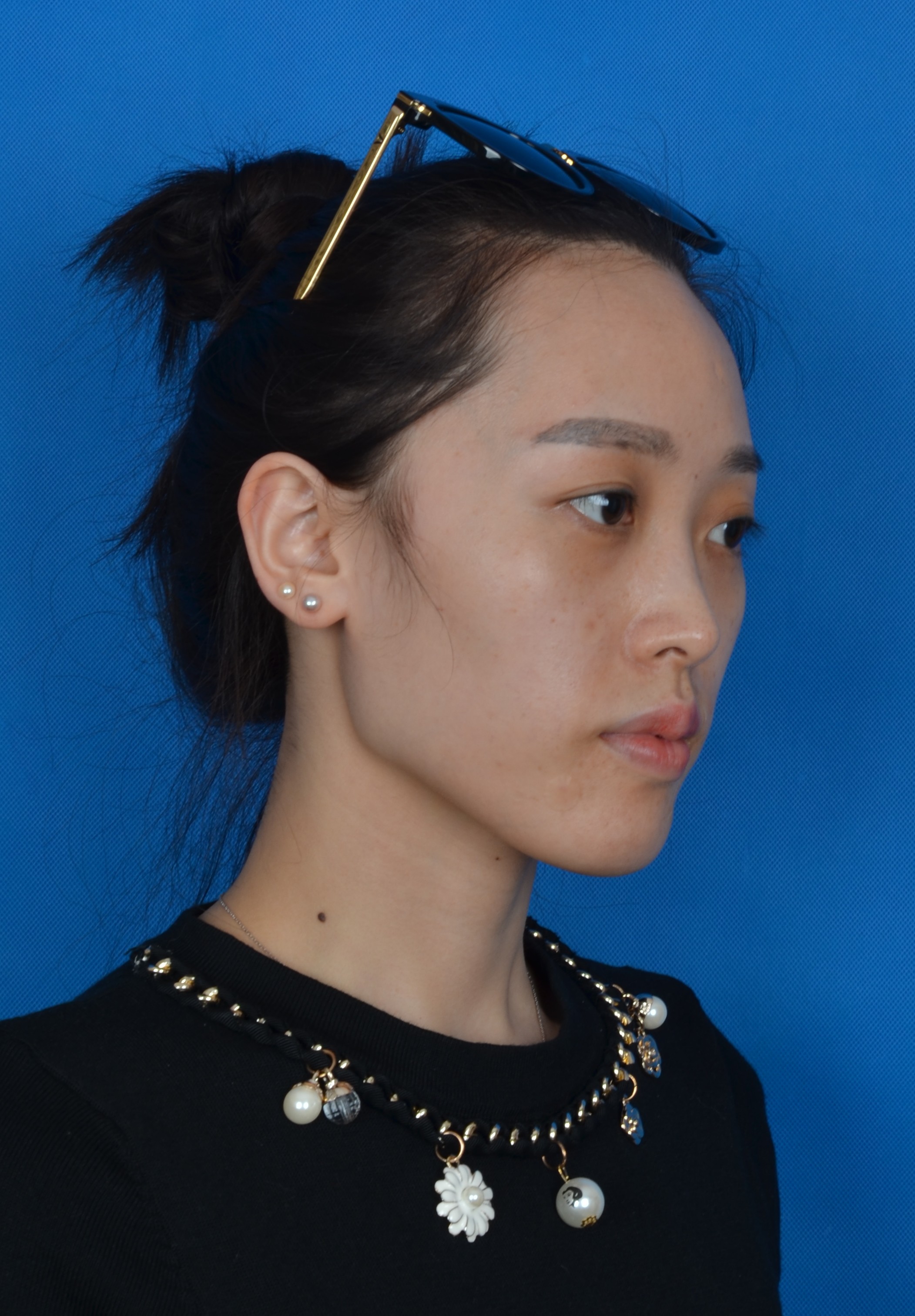 自体脂肪全脸填充怎么样_恢复过程_效果如何_小兔不白整形日记5.