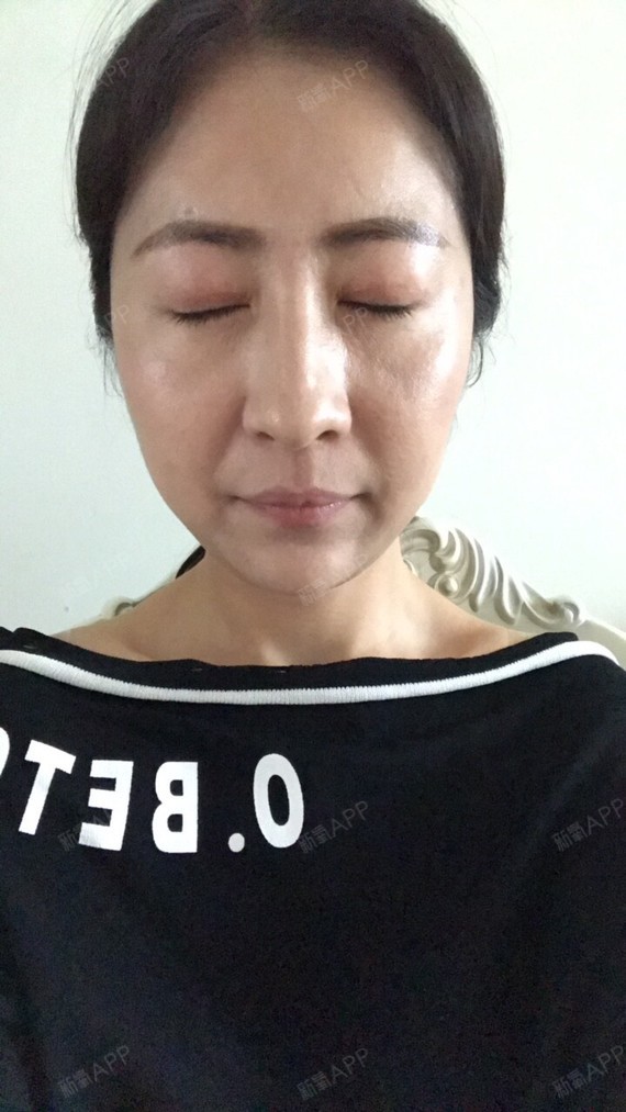 无美颜无化妆无p图的双眼皮修复分享!