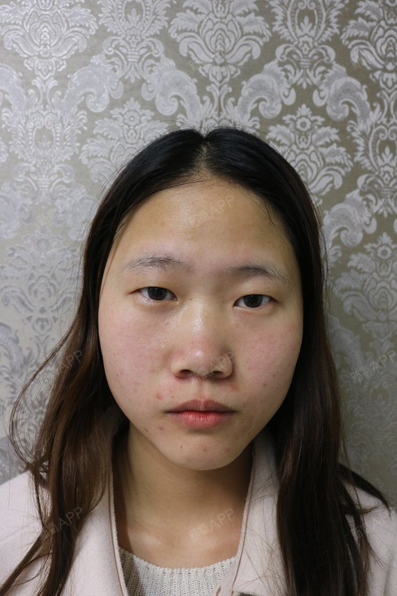 在眼皮越来越松弛的_圈子-新氧美容整形