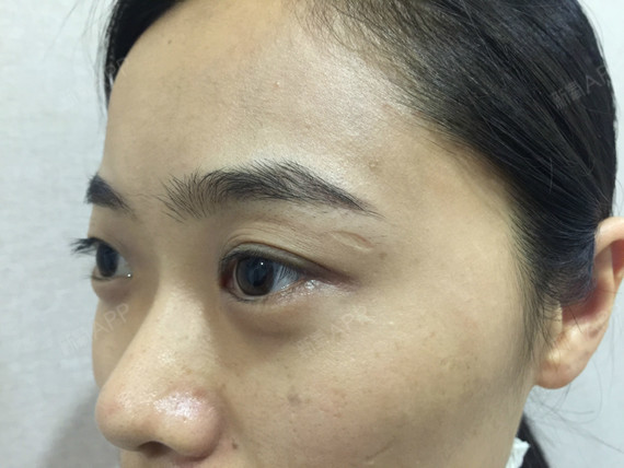 眼尾处的疤痕是玻璃划伤的,我这个纯属意外造成的凹陷_圈子-新氧美容
