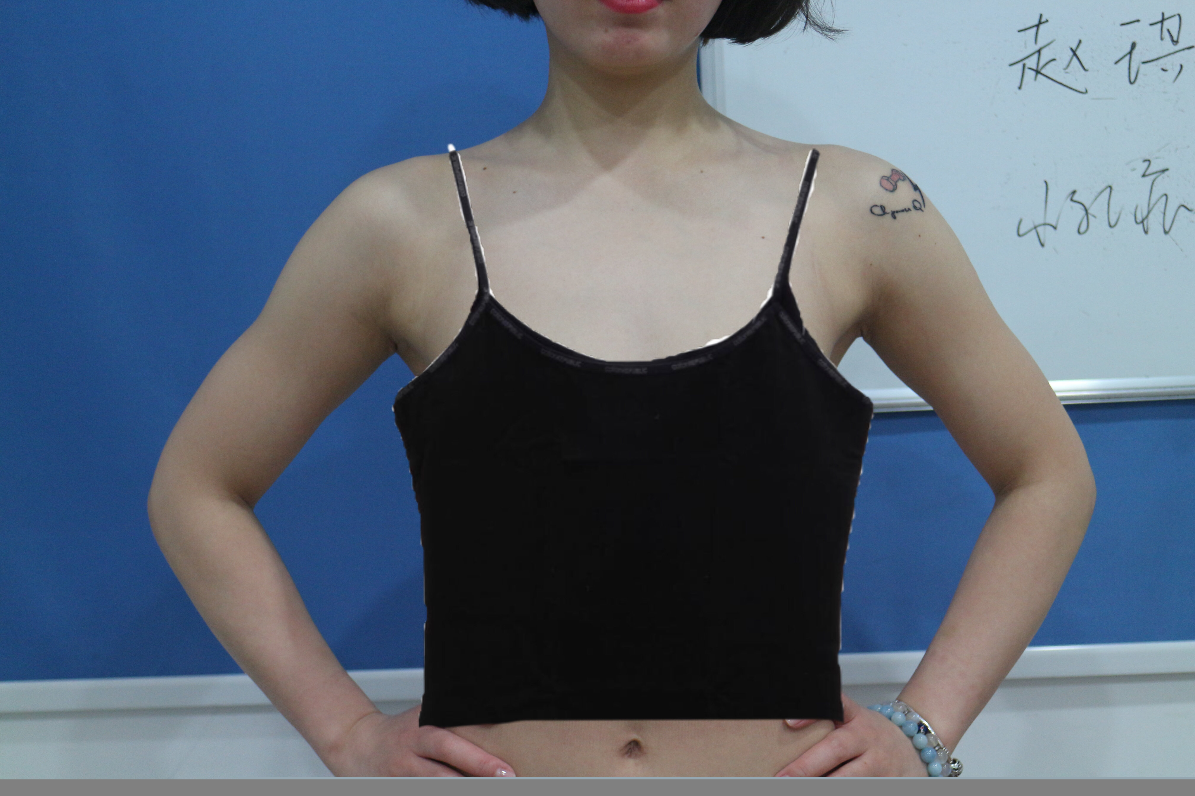 上海假体隆胸个人案例分享；1个月恢复记录 - 知乎