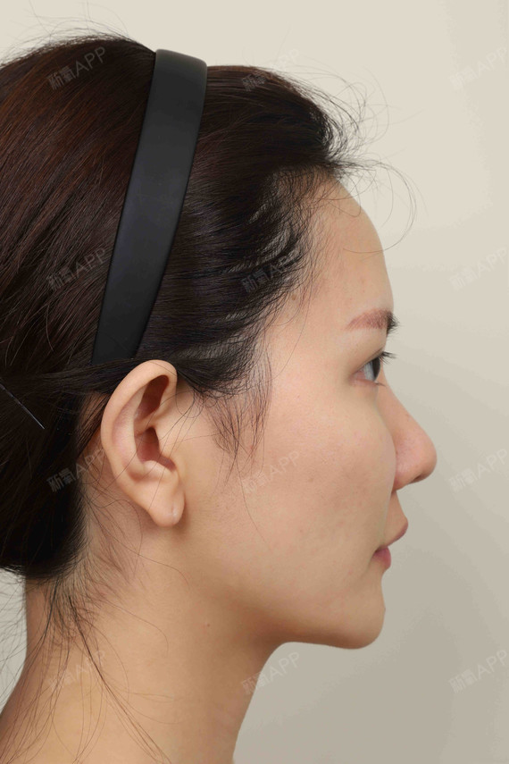 颧骨颧弓整形术