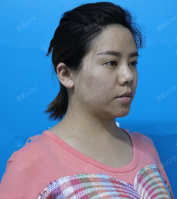 【爱多邦黎星激光溶脂瘦脸】