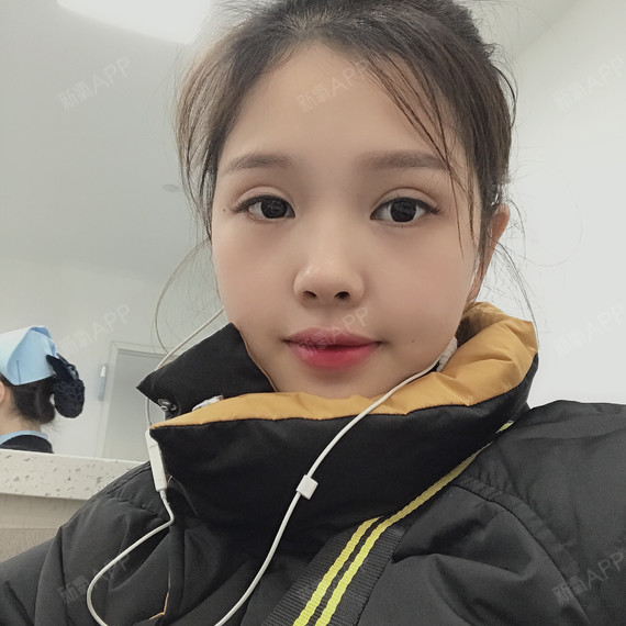我做的是埋线酒窝哦,现在第6天了,酒窝还是很明显,_圈子-新氧美容整形