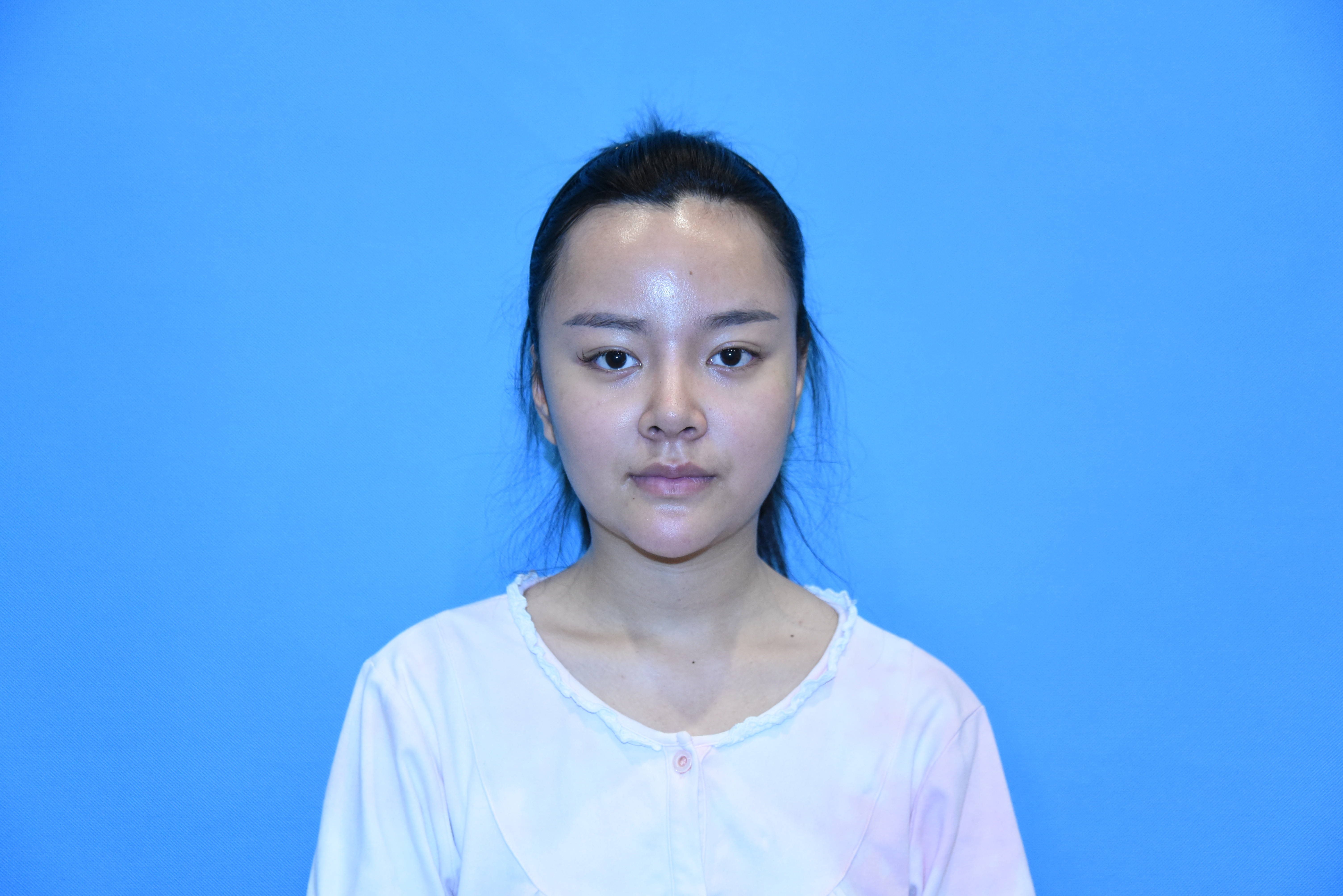 填充面部脂肪多少钱_填充面部脂肪以后能吃海鲜吗_脂肪的填充面部