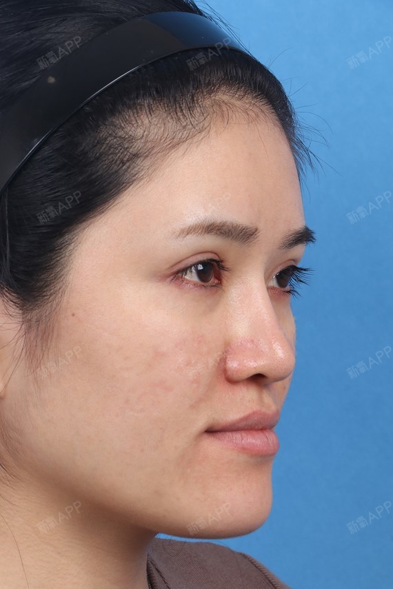 假体垫鼻基底第5天了,现在脸上已经消肿很多啦,身边_圈子-新氧美容