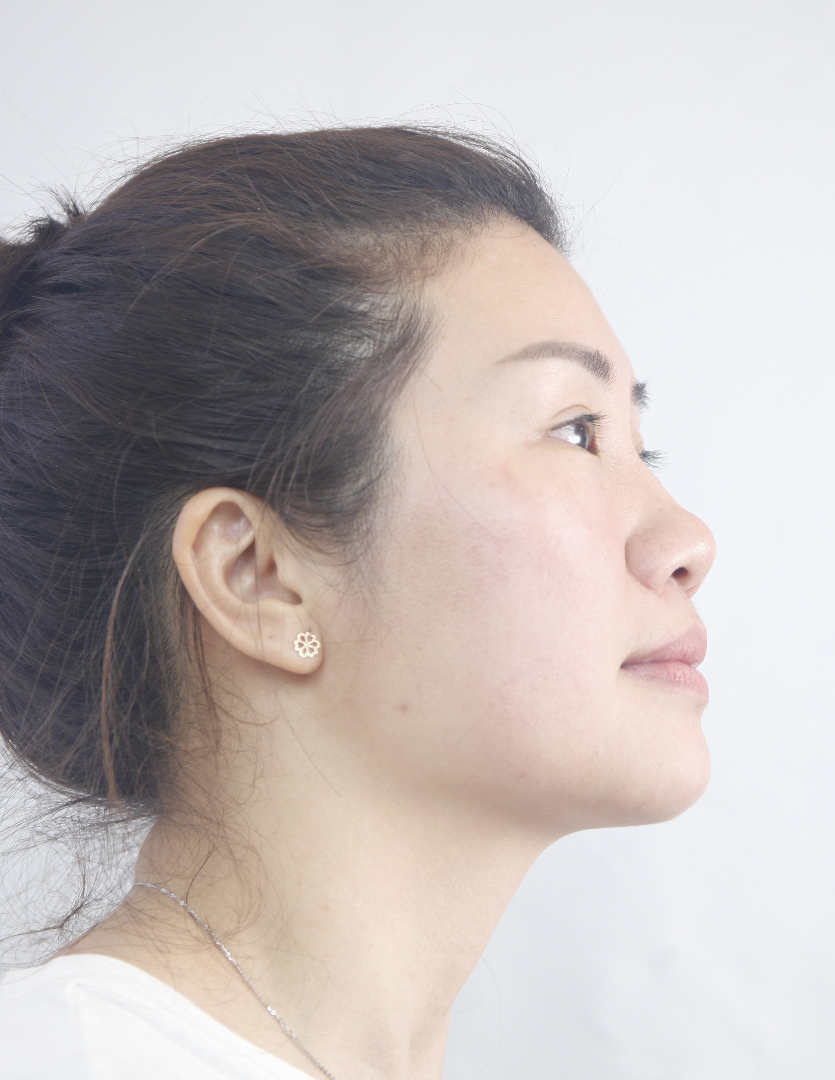 【20代女性・鼻先の形を綺麗に】耳介軟骨移植（1週間後） - 症例写真 - 美容整形、美容外科なら聖心美容クリニック