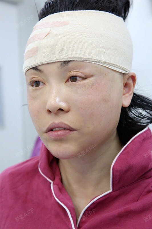 我这个年纪有些浮肿是正常的,但是我见到了非常年轻