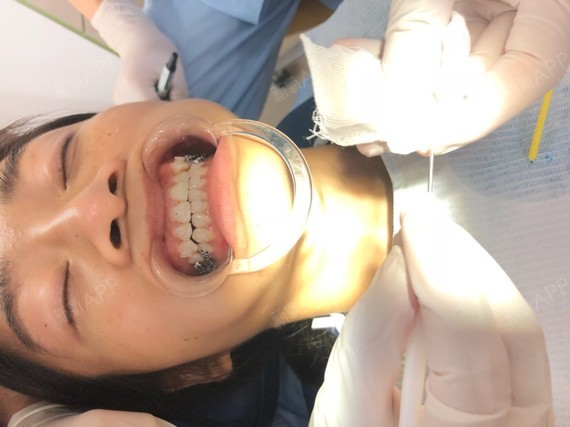 牙套已经粘好了,在粘的时候拍照看,感觉基本都看不出_圈子-新氧美容