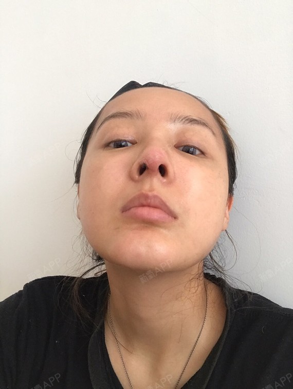 今天来个正面照.还有鼻小柱切口的恢复.